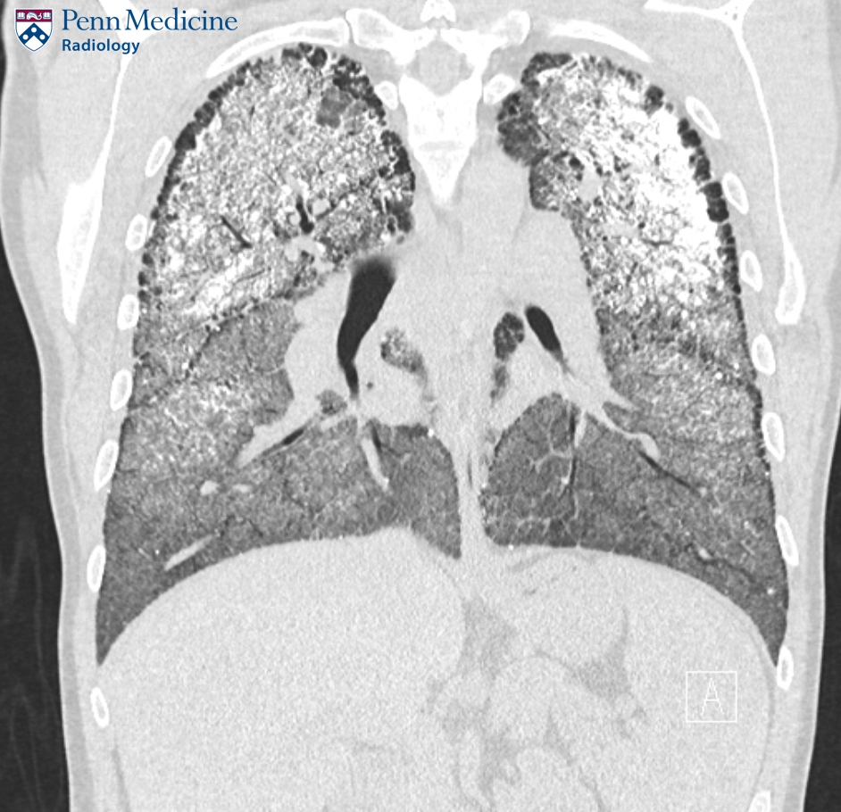 42-year-old man with shortness of breath