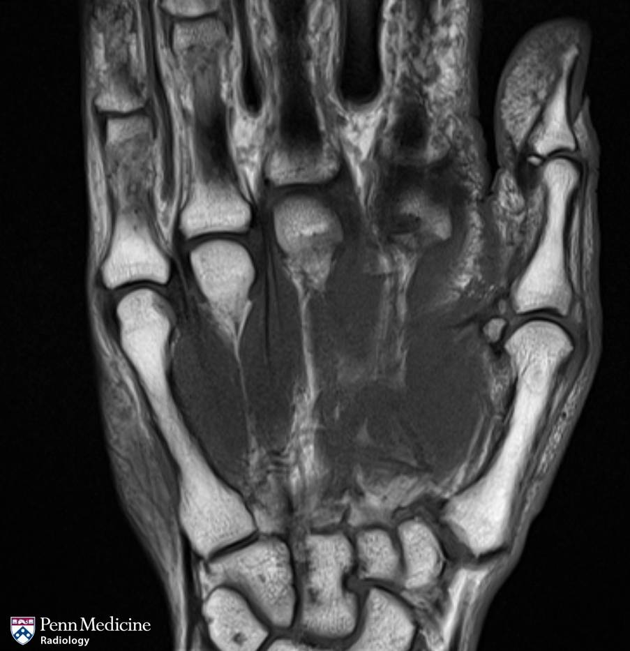 70-year-old woman with thumb pain