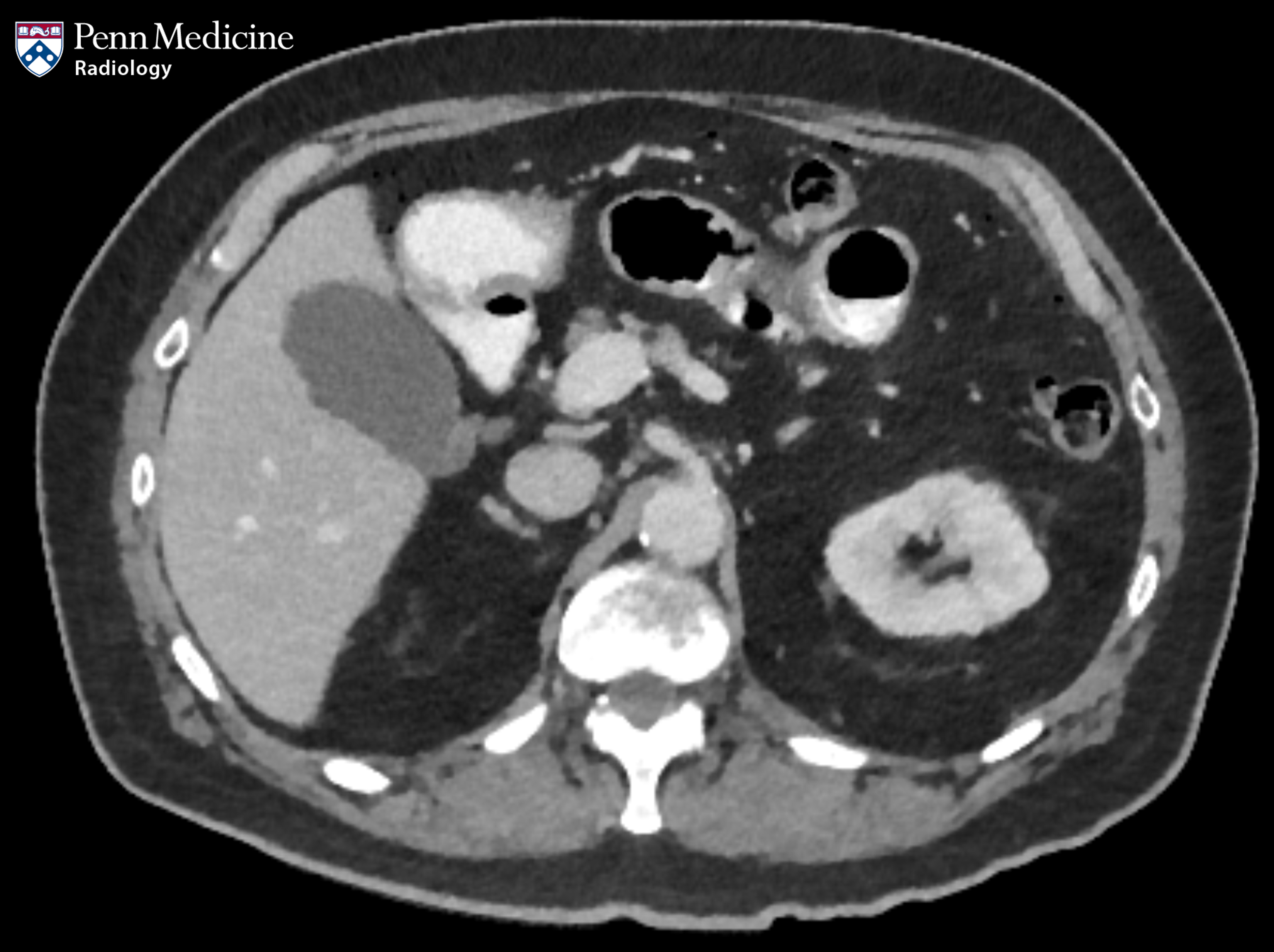 71-year-old man with acute abdominal pain