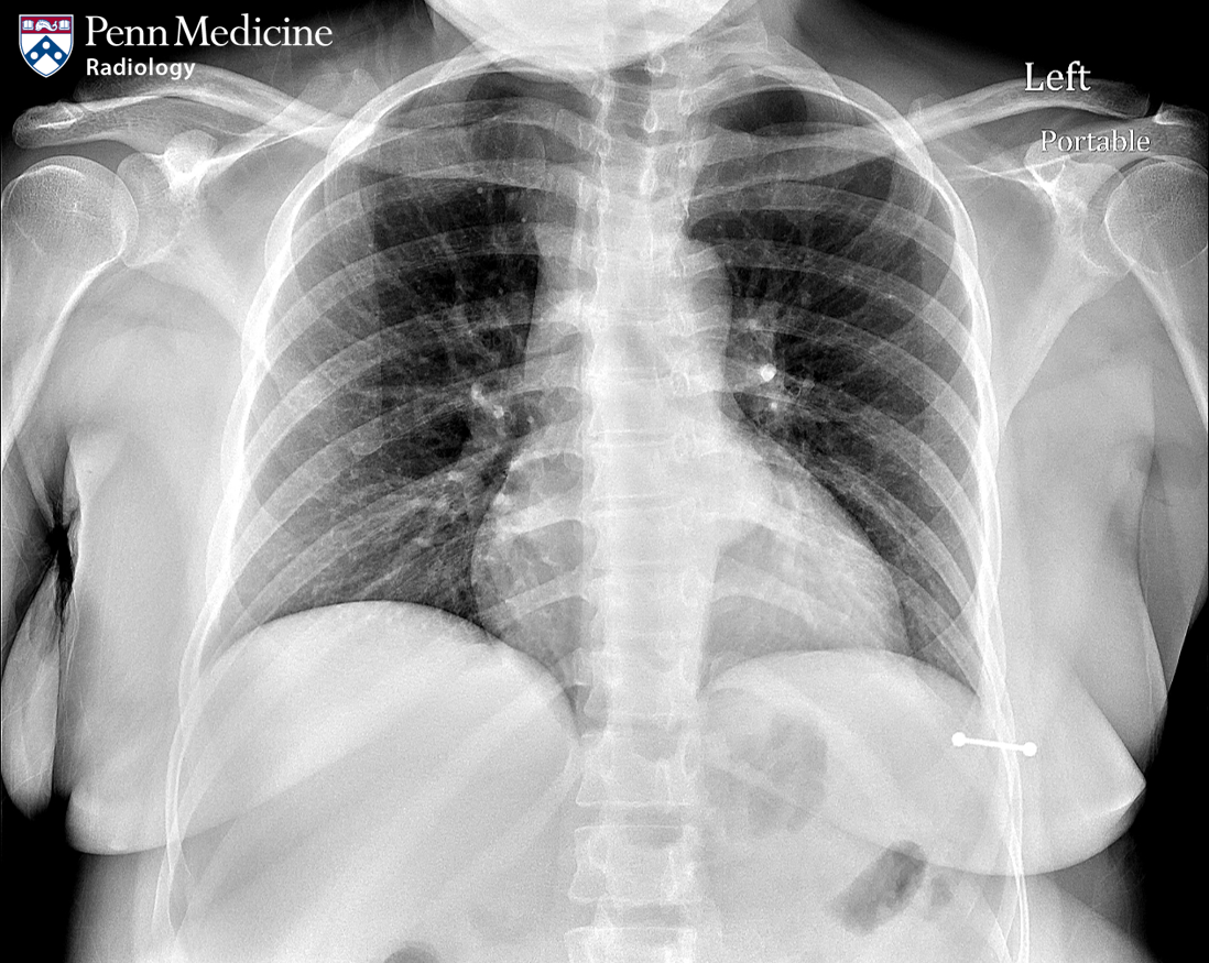 31-year-old woman with chest x-ray finding