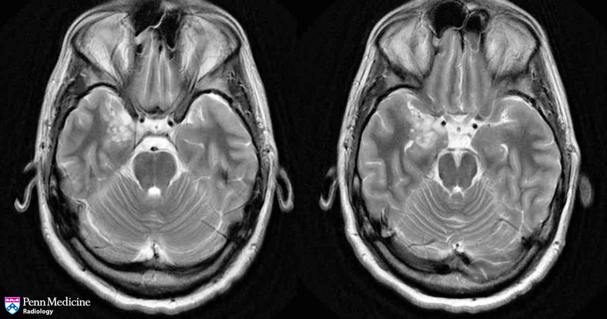 29-year-old man with complex partial seizures