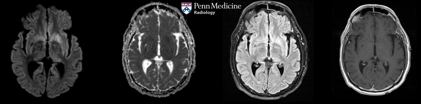 62-year-old man with progressive cognitive decline