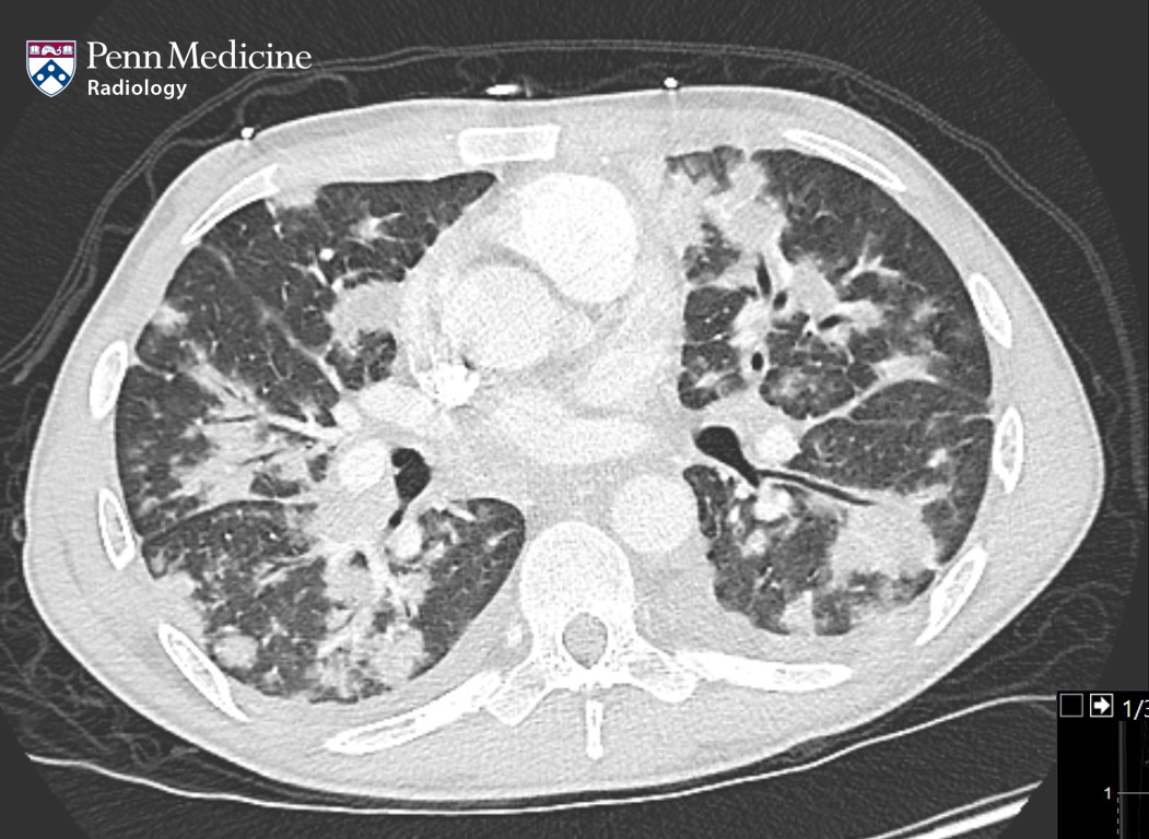 34-year-old man with hemoptysis