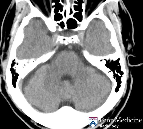 59-year-old man with sudden onset left-sided weakness