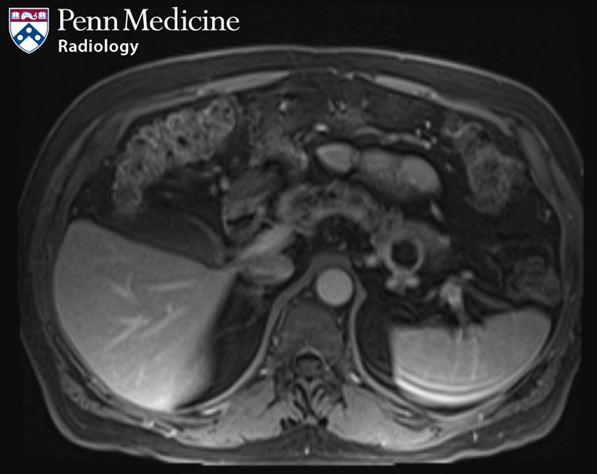 69-year-old man with an incidental finding on MRI