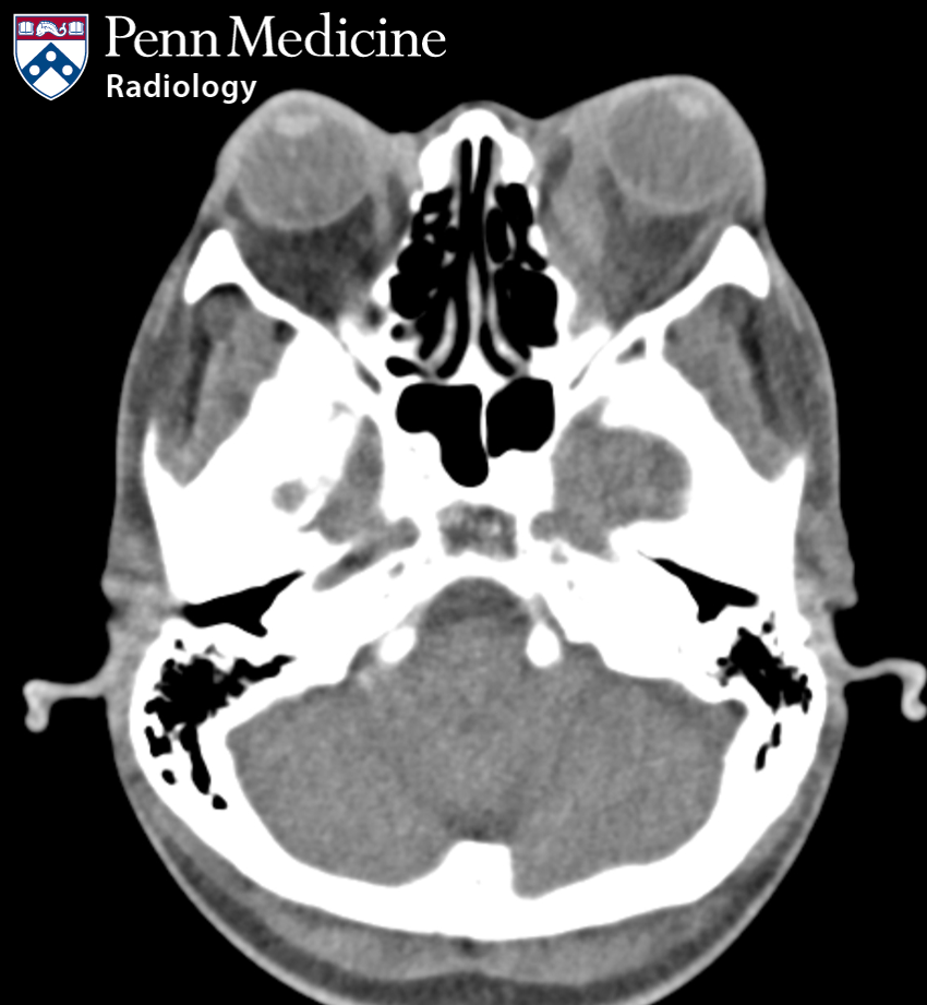 48-year-old woman with diplopia