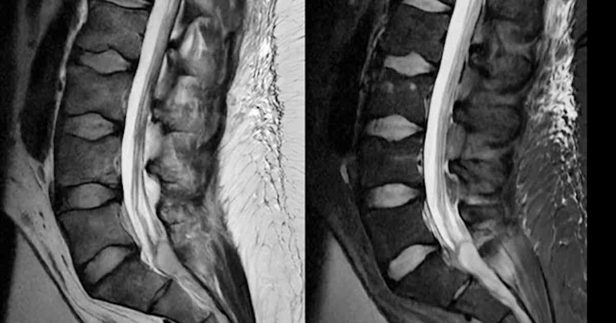 38-year-old man with back pain, radiculopathy, and fever