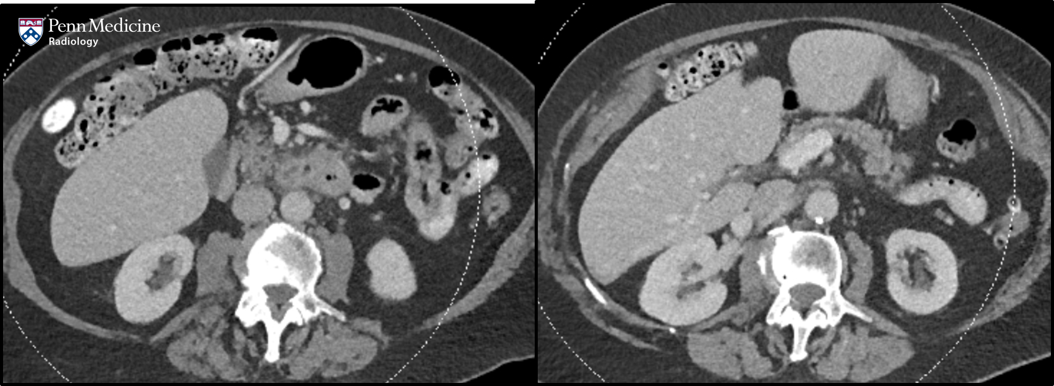75-year-old woman with abdominal pain and nausea