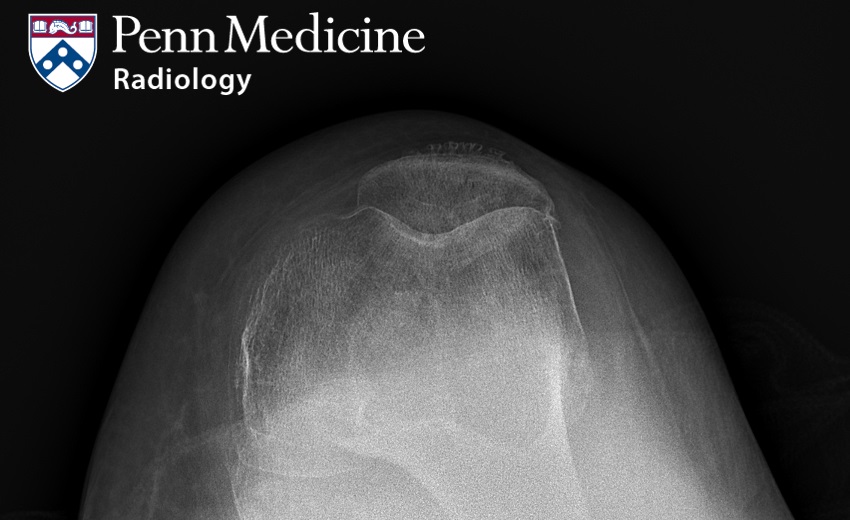 56-year-old woman with joint pain