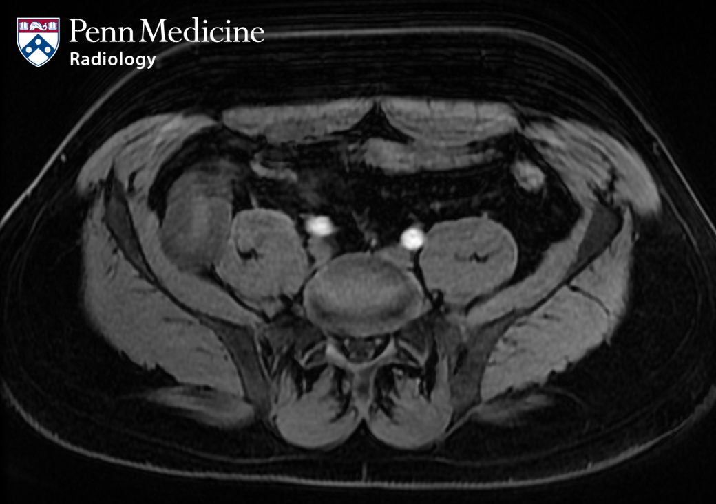 30-year-old man with diarrhea
