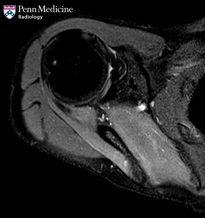 37-year-old man with shoulder weakness