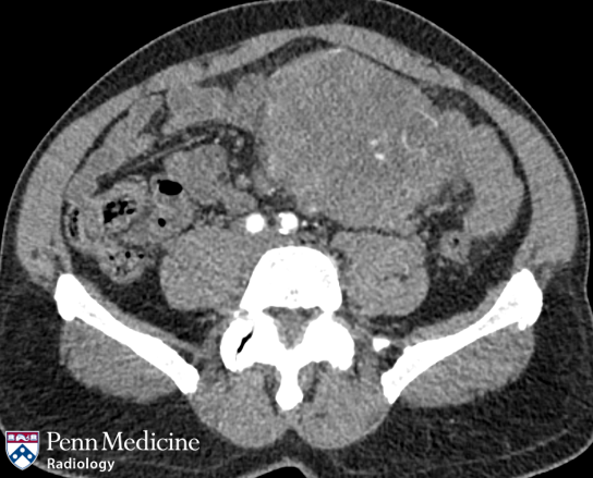 60-year-old man with persistent abdominal pain and early satiety