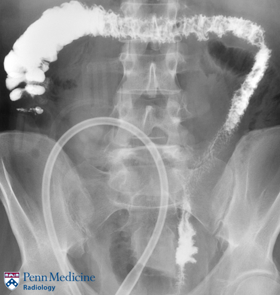 44-year-old man with follow-up for low anterior resection for rectal cancer