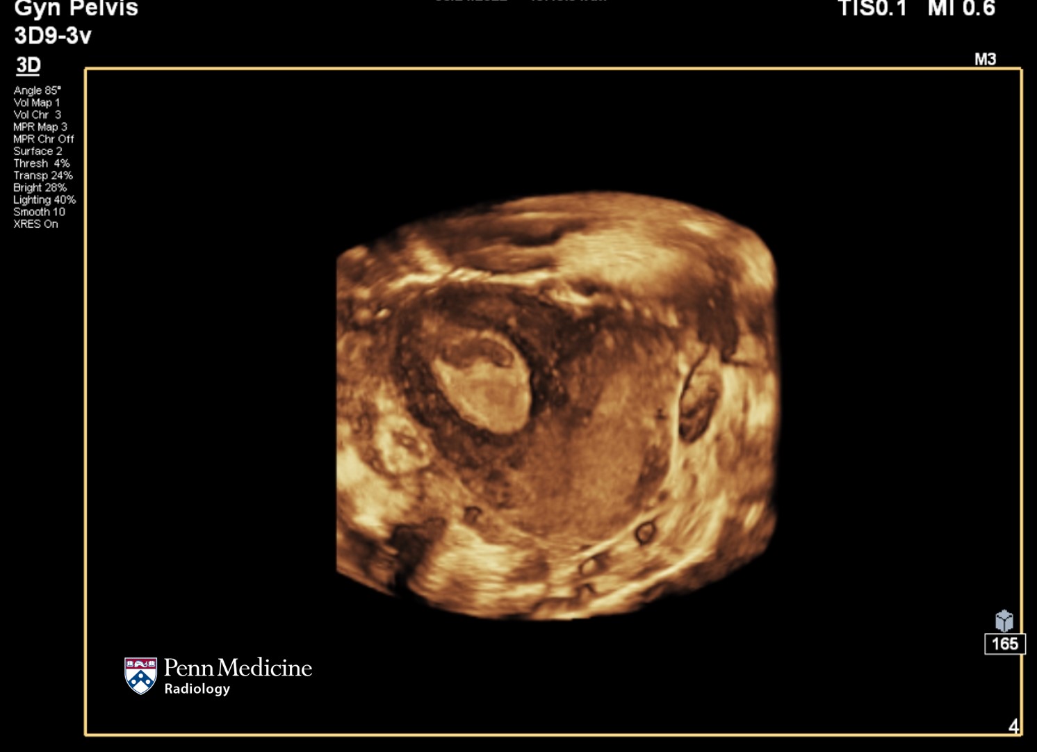 21-year-old woman with intermittent pelvic pain