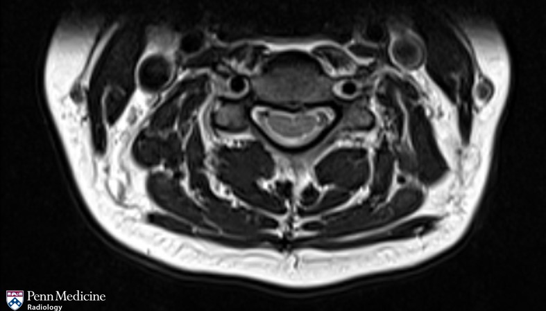 45-year-old woman with severe neck pain, trismus, odynophagia