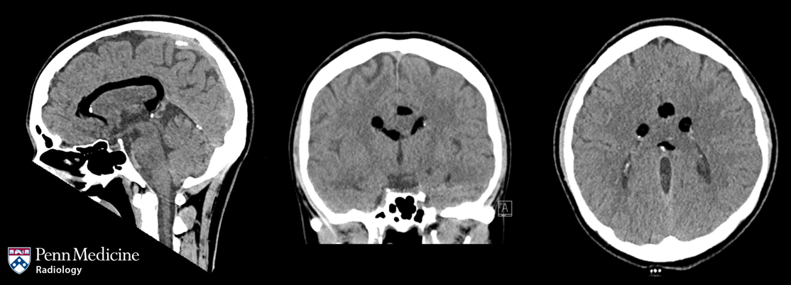 29-year-old woman with numbness and tingling of the extremities