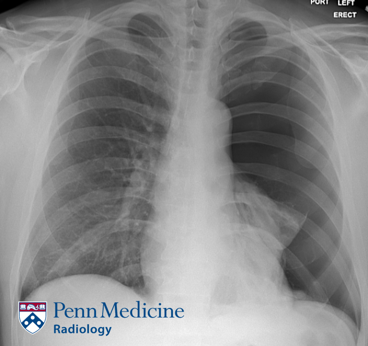 61-year-old man with chest pain