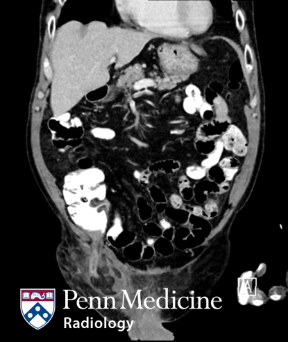 74-year-old man with right lower quadrant pain