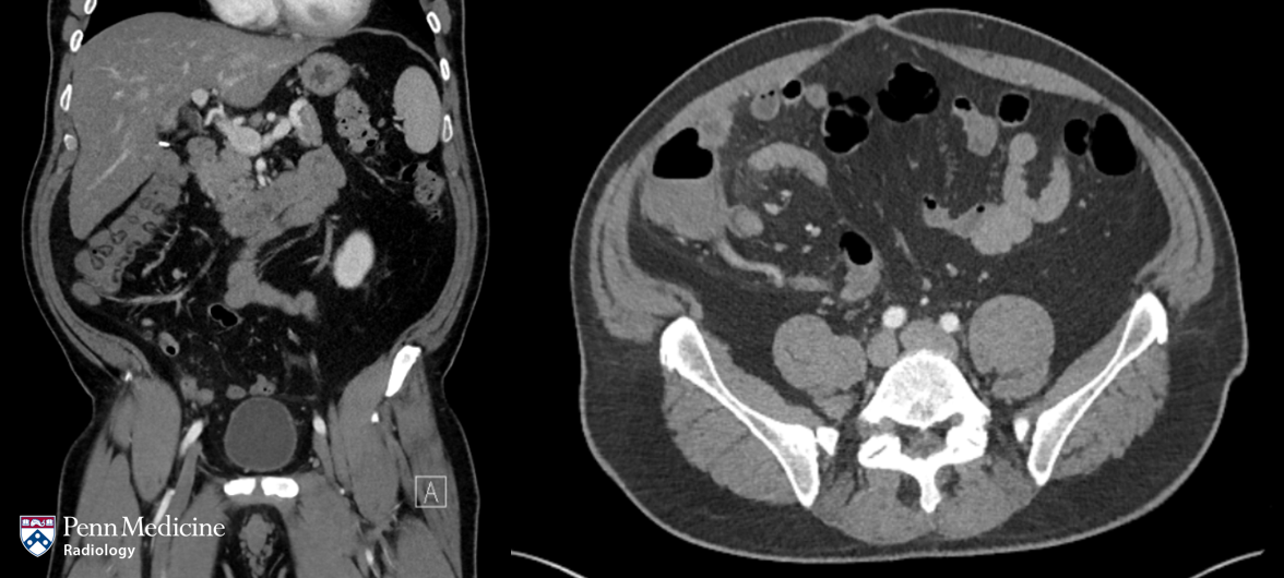51-year-old man with right lower quadrant pain