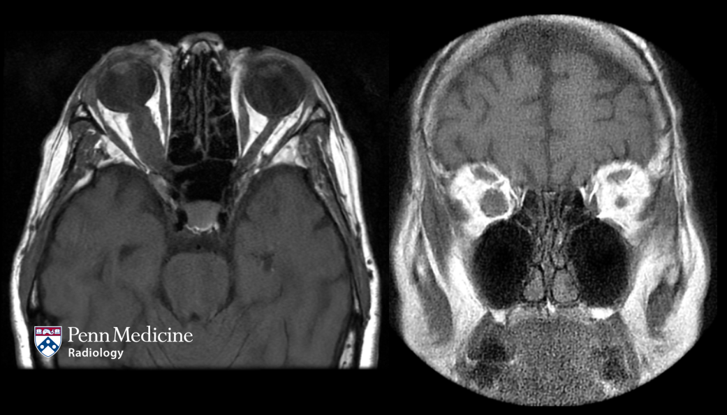 66-year-old woman with gradually worsening vision