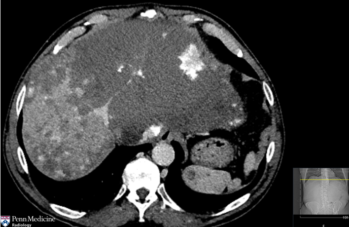 74-year-old-man with abdominal pain