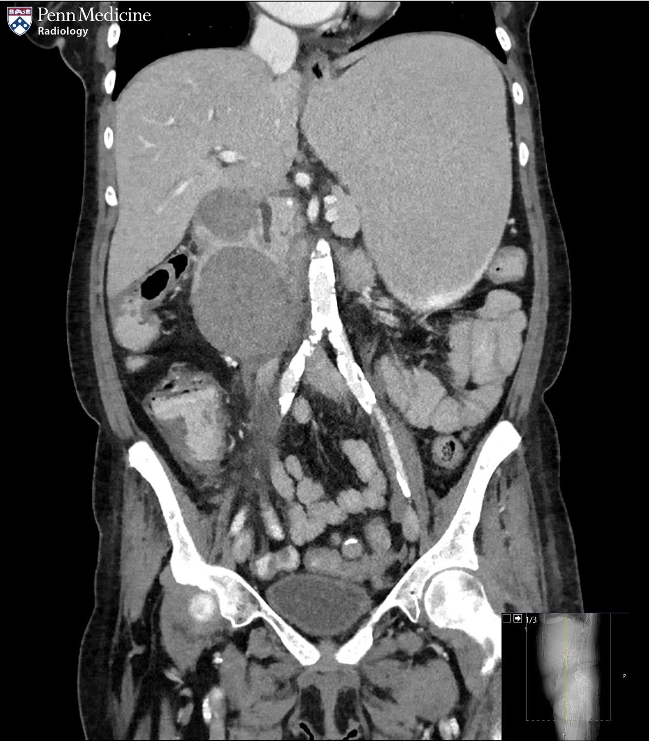 56-year-old woman with nausea and vomiting after endoscopic procedure