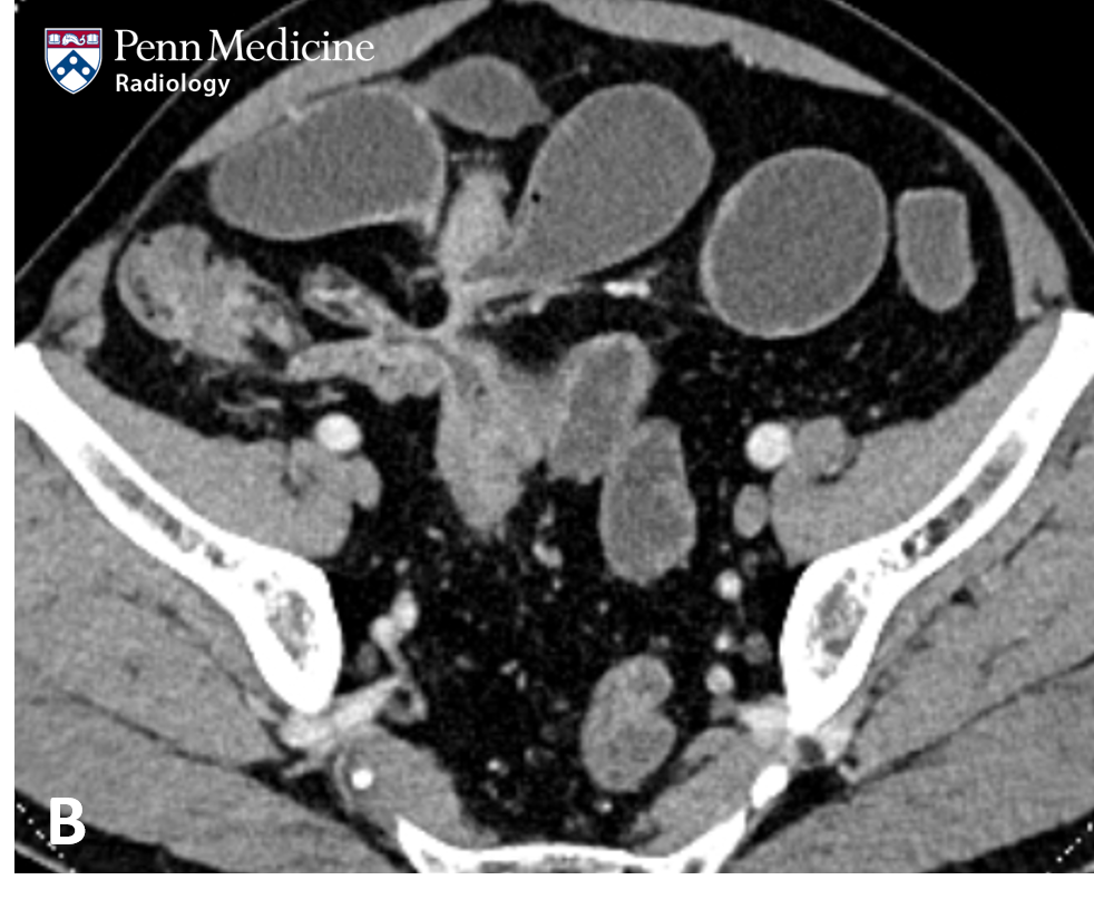 52-year-old man with abdominal pain, leukocytosis, and elevated CRP