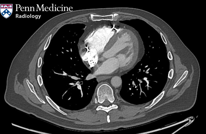 52-year-old man with shortness of breath