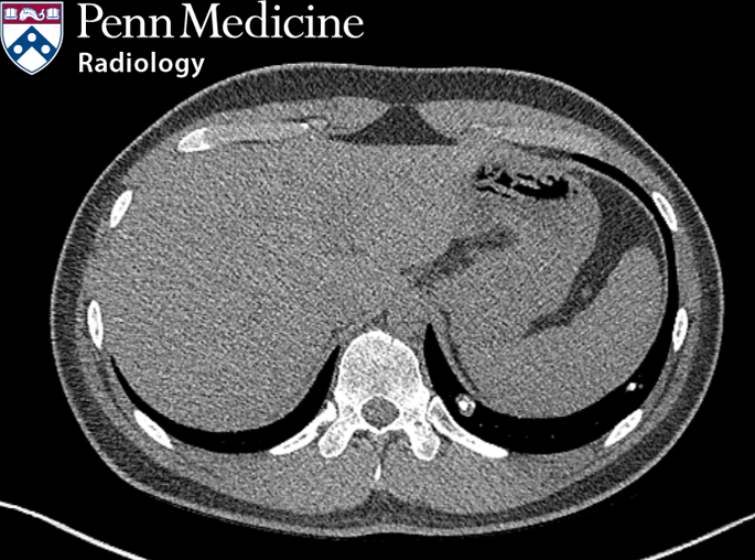 19-year-old man with lung nodules