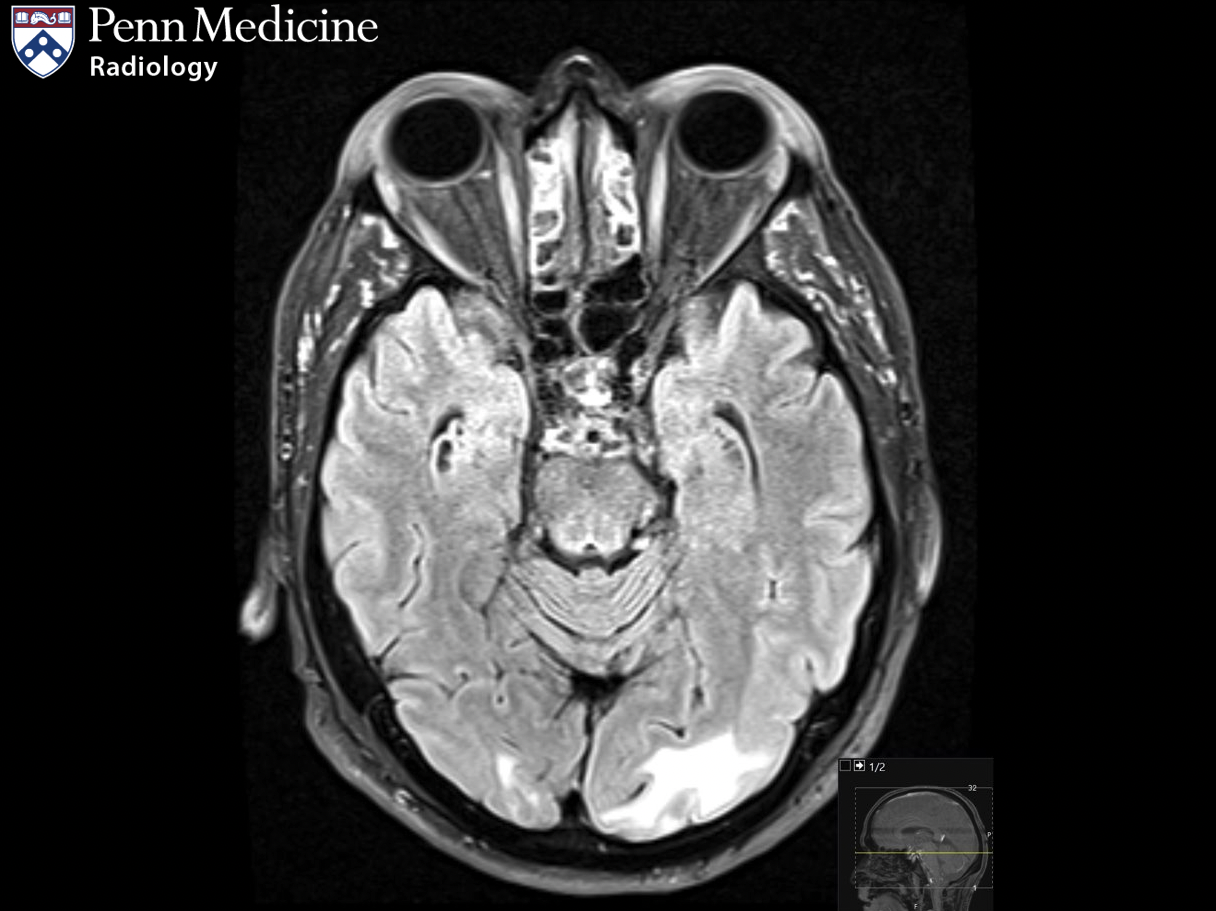 54-year-old man presenting with hypertension and loss of vision