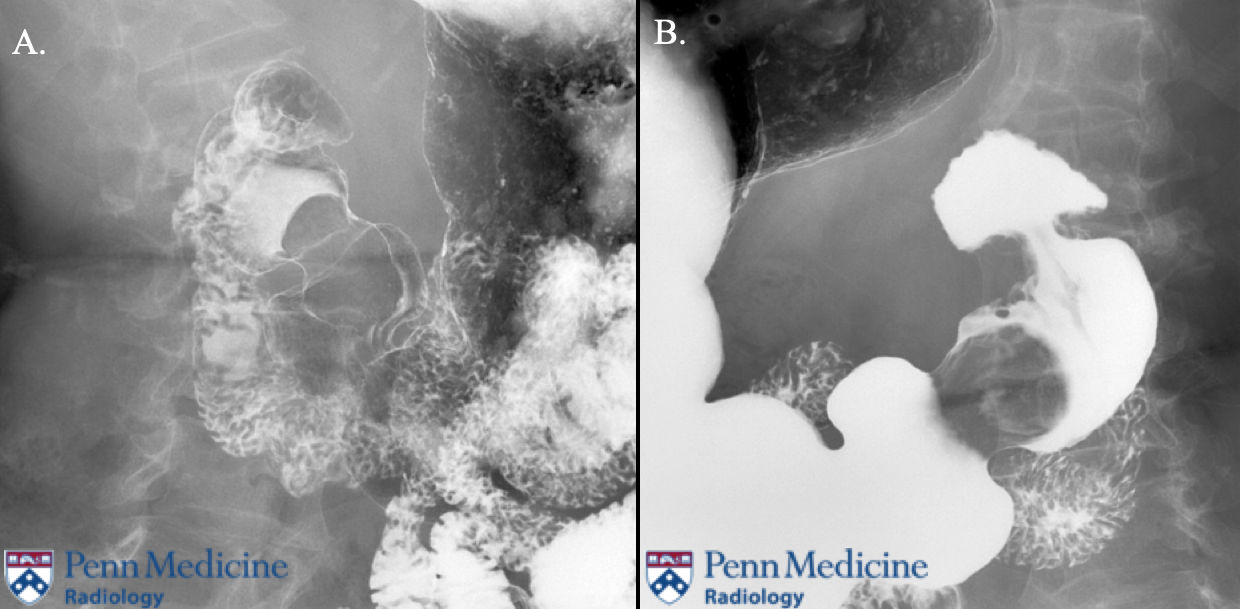 71-year-old woman with chronic cough