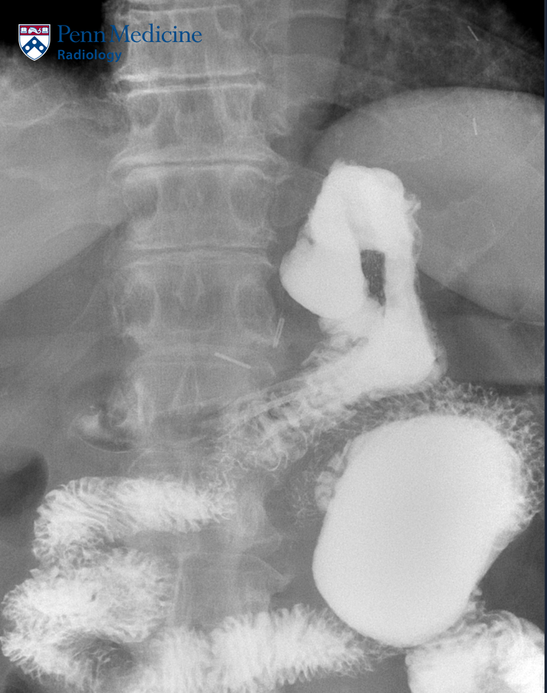 60-year-old woman with chronic dyspepsia and nausea