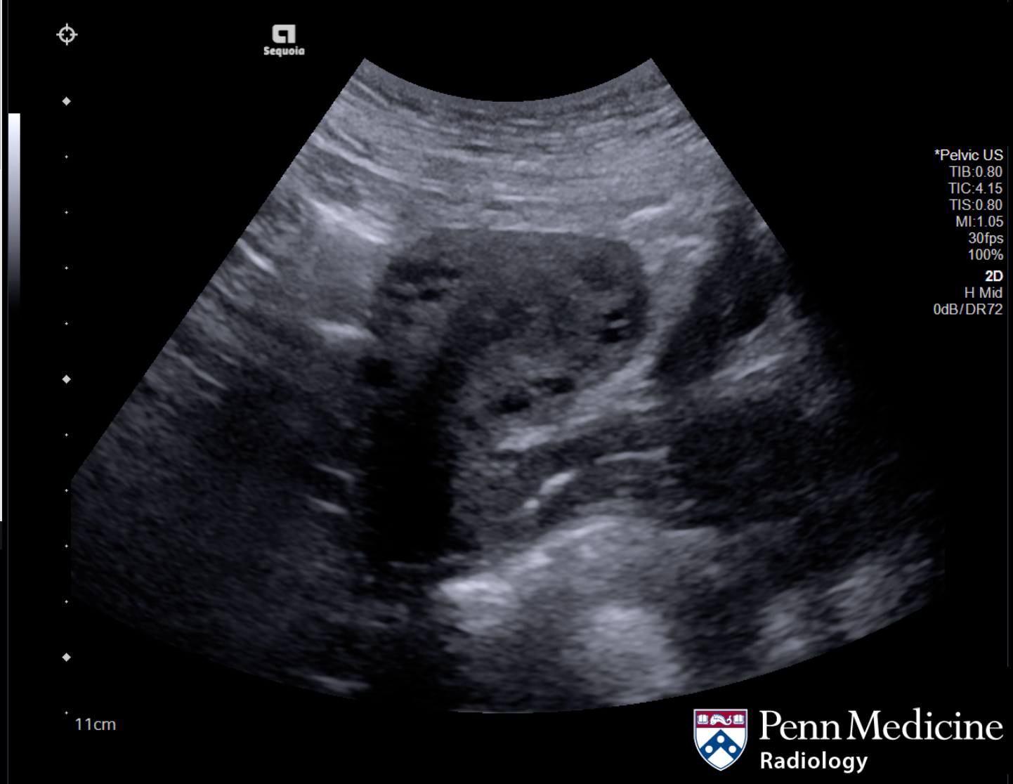33-year-old woman with pelvic pain
