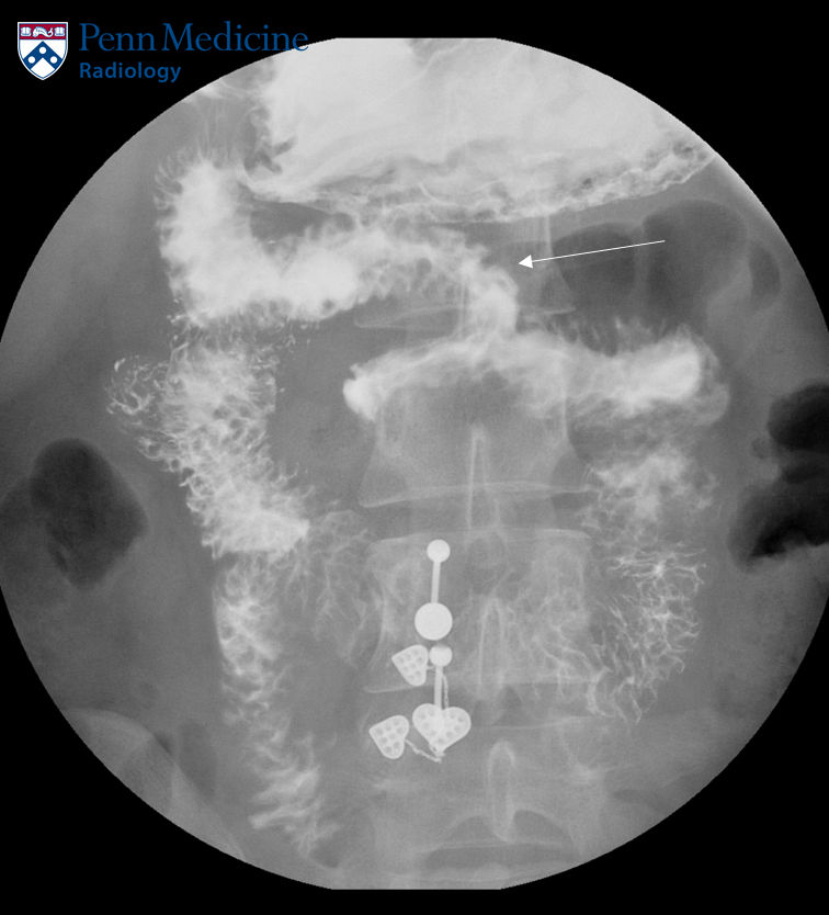 21-year-old woman with acute abdominal pain and vomiting