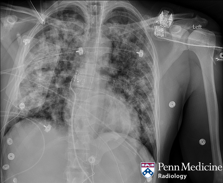 29-year-old man presents with dyspnea
