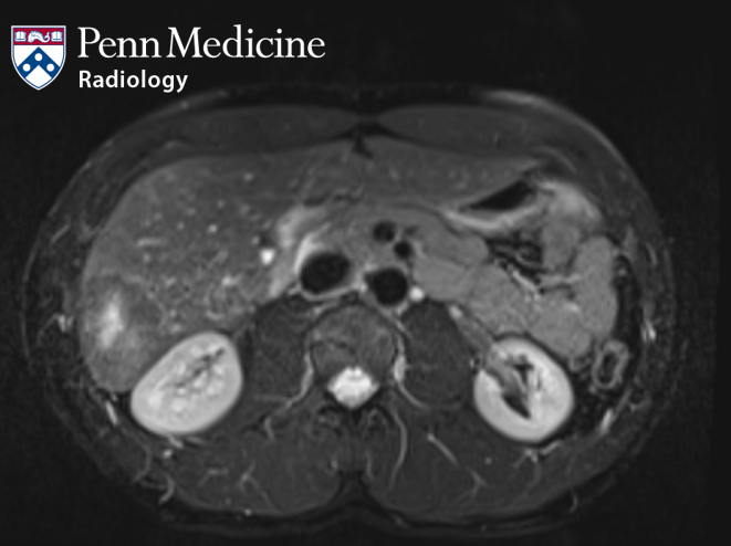 32-year-old man with incidental liver lesion