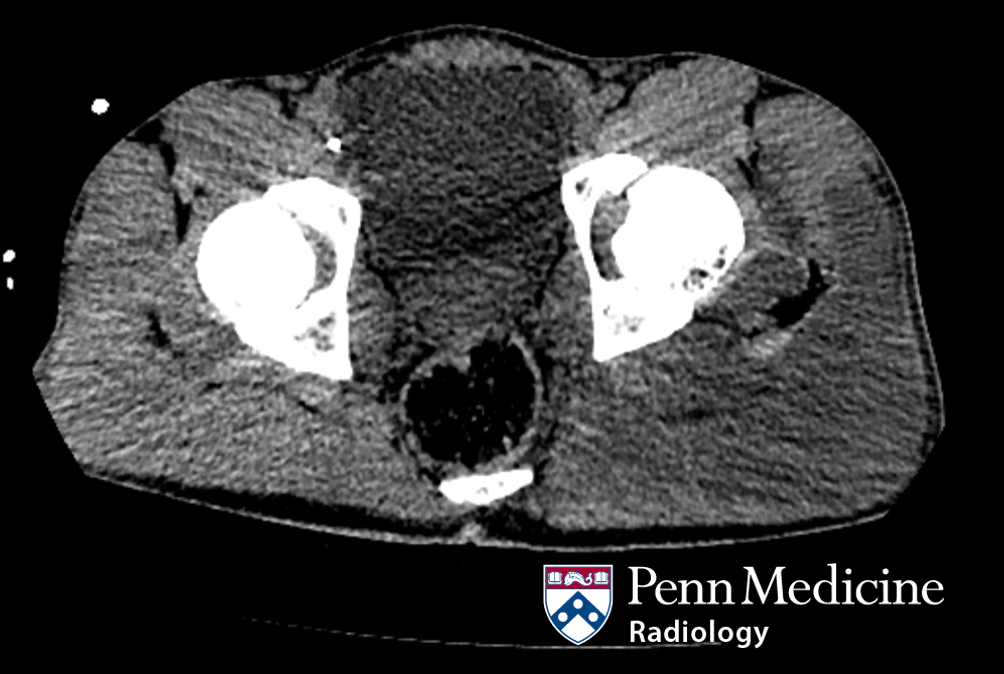 33-year-old man with blood in urine