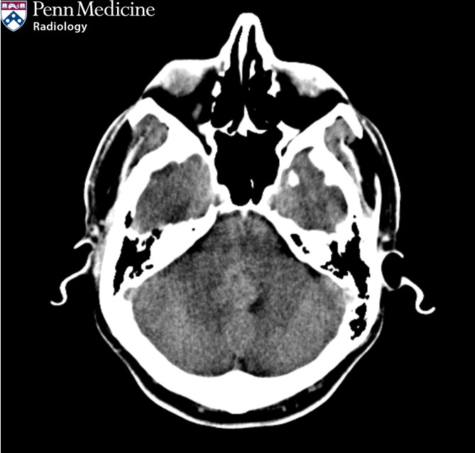 44-year-old man with recurring falls