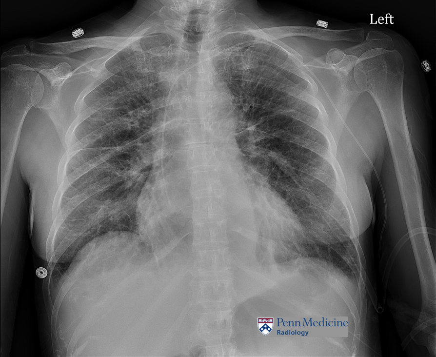 59-year-old woman with chronic shortness of breath