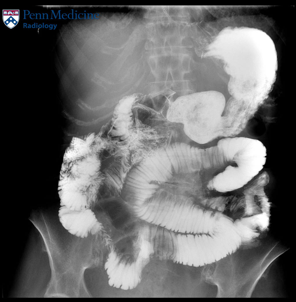69-year-old woman with abdominal pain