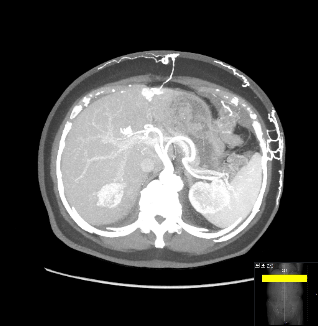 86-year-old woman with abdominal pain