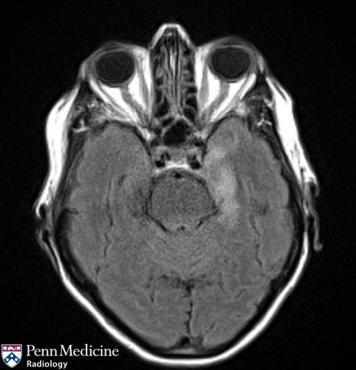 84-year-old woman with altered mental status and urine incontinence