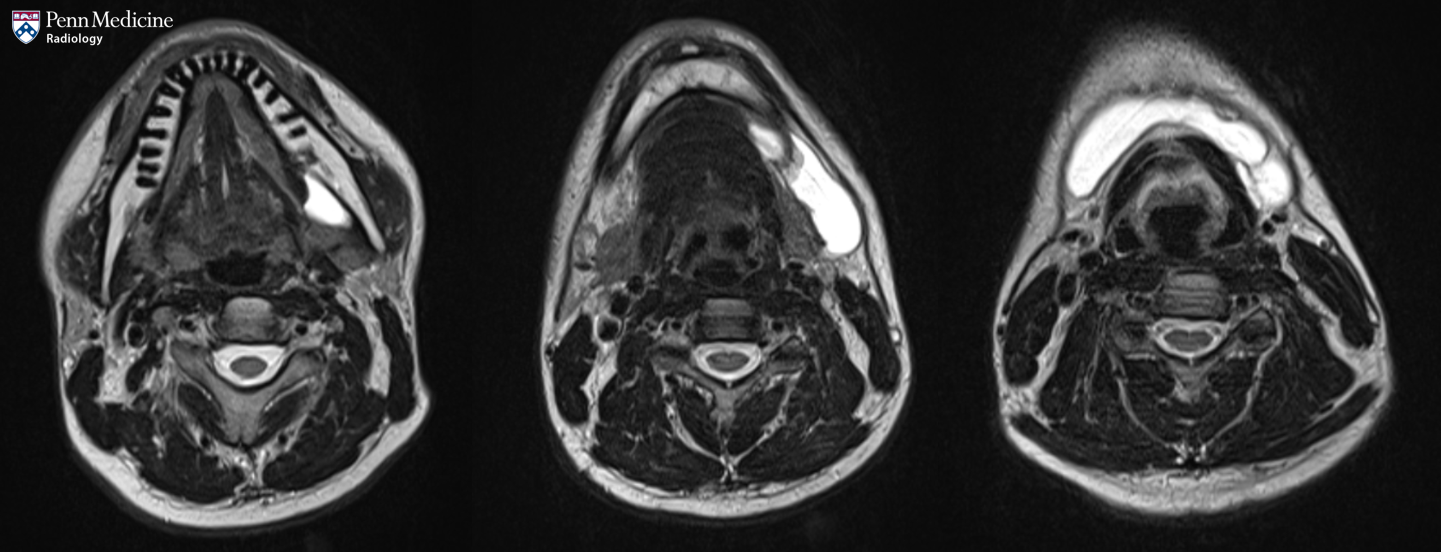 28-year-old man with a lump on his neck
