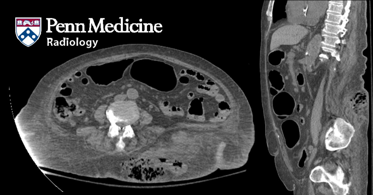 70-year-old woman with fever and left flank pain