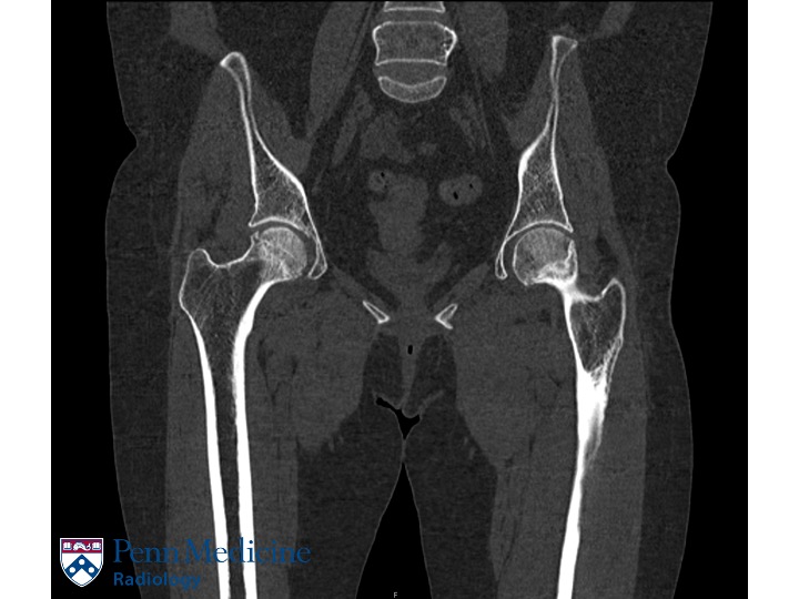 51-year-old woman with bilateral hip pain