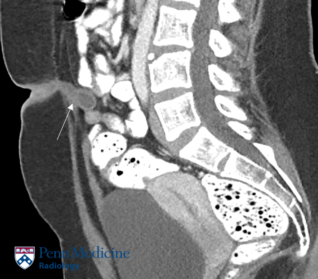 23-year-old woman with umbilical pain