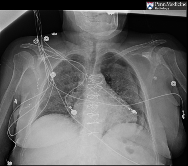 68-year-old woman presenting with dyspnea