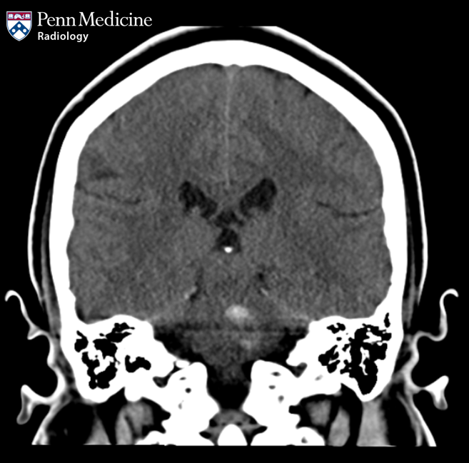 28-year-old woman with headache and neurologic deficits