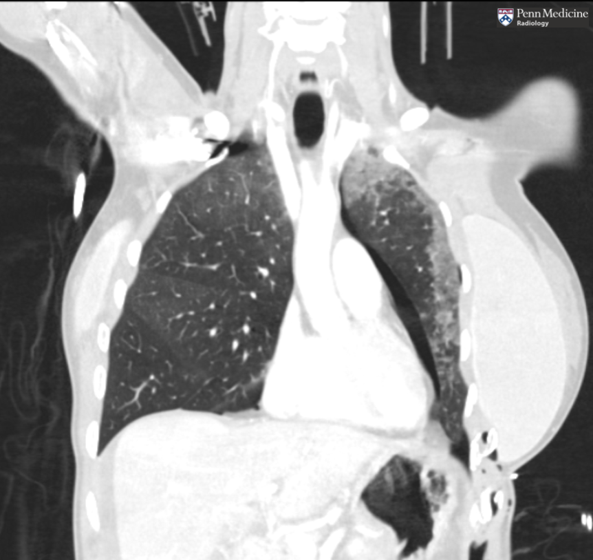 38-year-old woman presenting after motor vehicle rollover