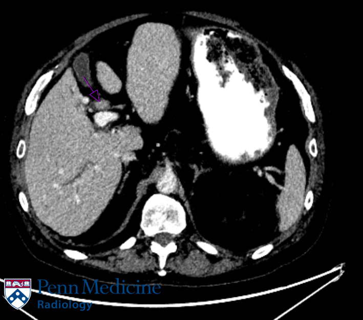 70-year-old man with epigastric pain